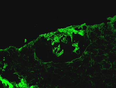 ANCA-Associated Vasculitis With <mark class="highlighted">Anti-GBM Disease</mark> and Two Types of Tumors: A Case Report